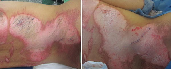 how long does it take for road rash to heal