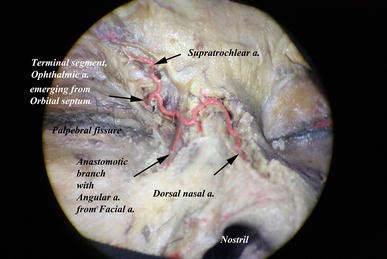 ophthalmic artery dissection
