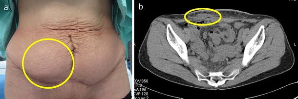 Chronic Expanding Hematoma Following Abdominoplasty | SpringerLink