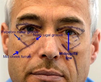 Concentric Malar Lift in the Management of Lower Eyelid Rejuvenation or  Retraction: A Clinical Retrospective Study on 342 Cases, 13 Years After the  First Publication | SpringerLink