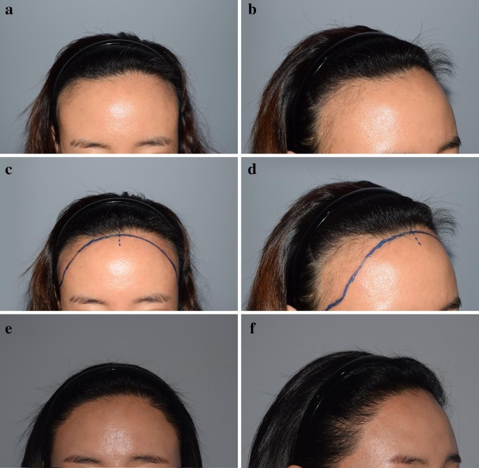 Secondary Revision of Female Hairline Correction Surgery: Personal  Experience | SpringerLink