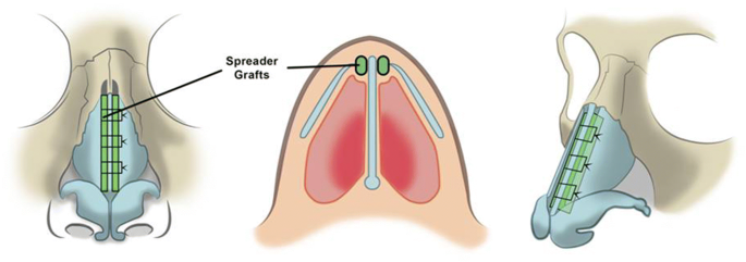 Surgical reconstruction or cosmetic alteration of the nose is termed Nasal Obstruction And Rhinoplasty A Focused Literature Review Springerlink