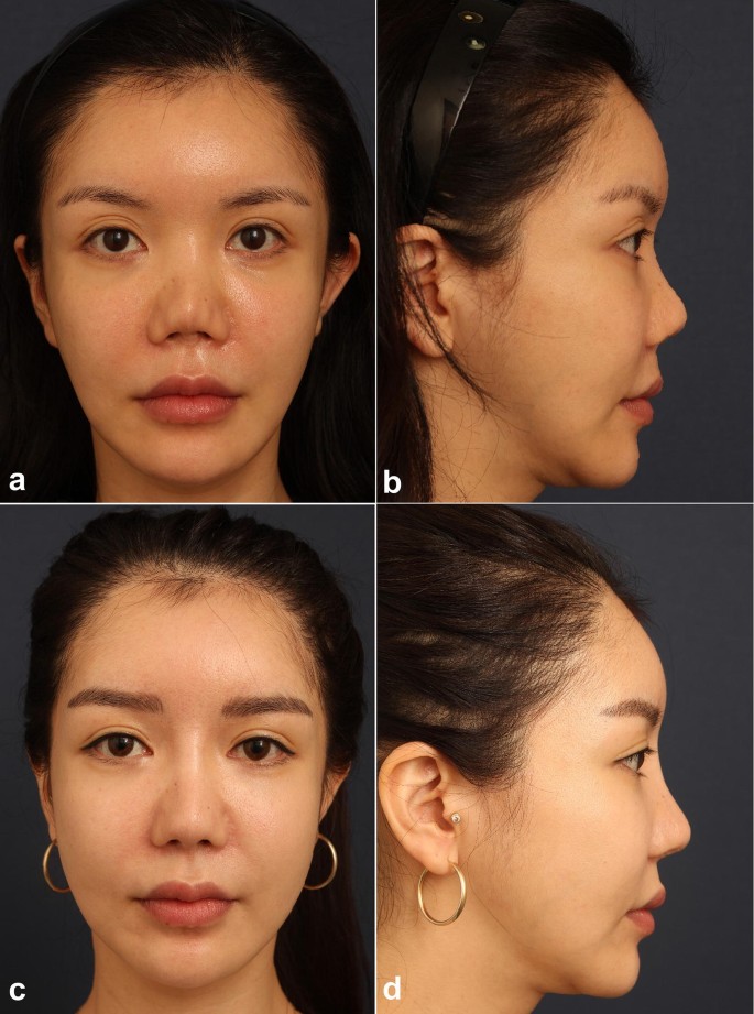 Multilayered Costal Cartilage Graft For Nasal Dorsal Augmentation Springerlink