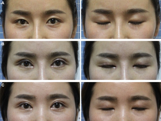 scarless double eyelid surgery