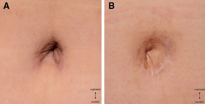 A Comparison Of Aesthetic Outcomes Of Umbilicoplasty In Breast Reconstruction With Abdominal Flap Inverted U Versus Vertical Oval Incision Springerlink