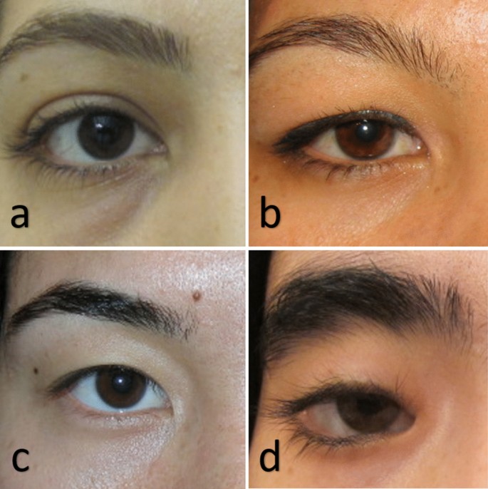 Revisiting Anchor Epicanthoplasty in Mild to Moderate Asian Epicanthal Folds:  A Clinicopathological Study | SpringerLink