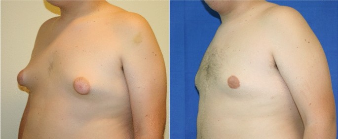 can bpc 157 cause gyno Gynecomastia: Ultrasound-Confirmed Classification Pertainent to Surgical  Correction | Aesthetic Plastic Surgery
