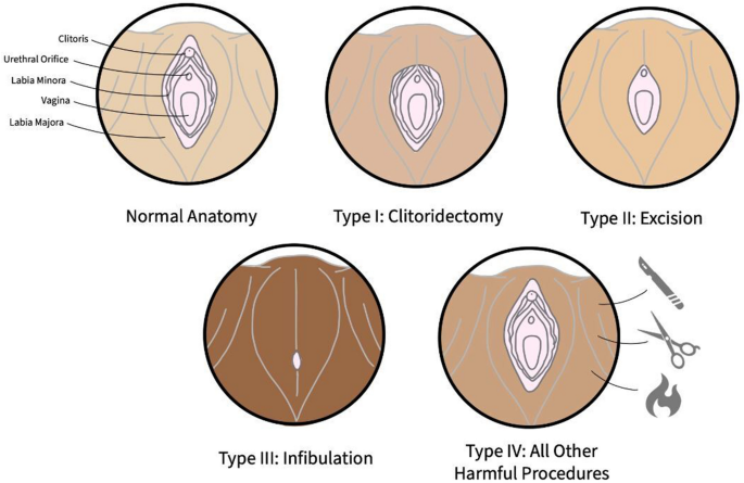 cut clitoris 