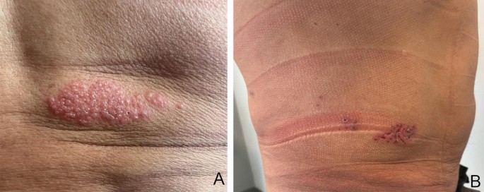 Herpes Zoster infection after trunk liposuction | SpringerLink
