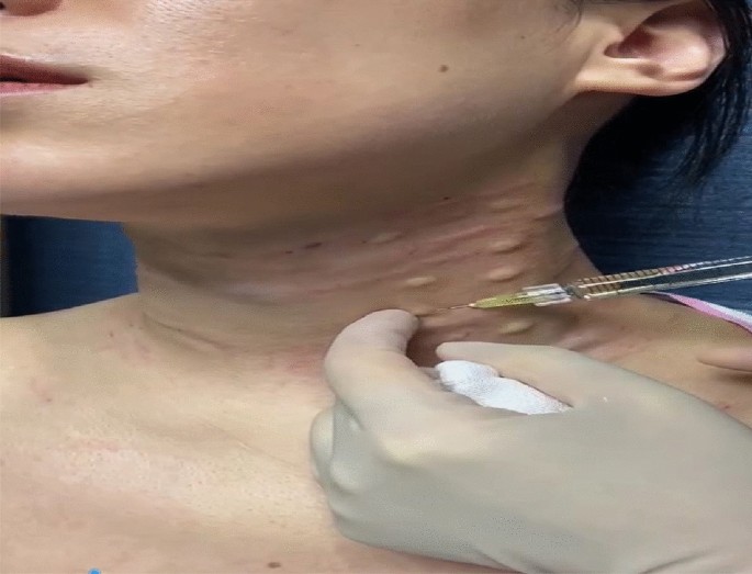 A Case Study: Comprehensive Approach for Treating Horizontal Neck Wrinkles  Using Hyaluronic Acid Injections and Thread-Lifting | Aesthetic Plastic  Surgery