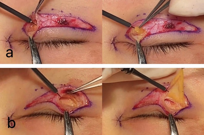 Eyelid Surgery Techniques