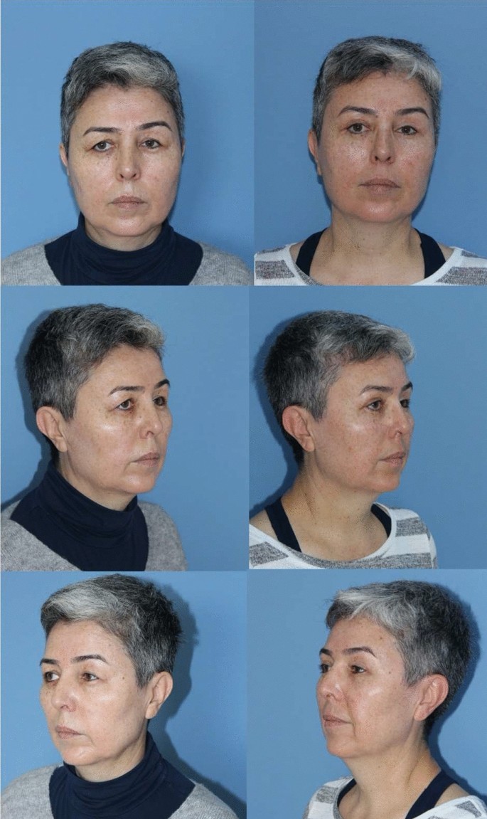 Abstracts | Aesthetic Plastic Surgery