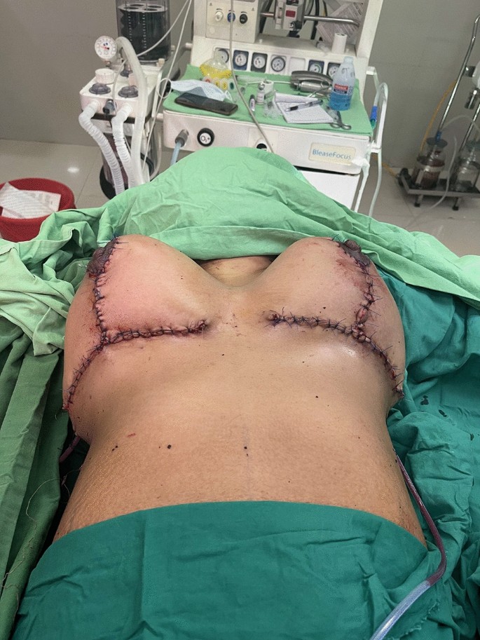 Breast Reduction Surgery Procedure & Postoperative Care - Dr. Rajat Gupta