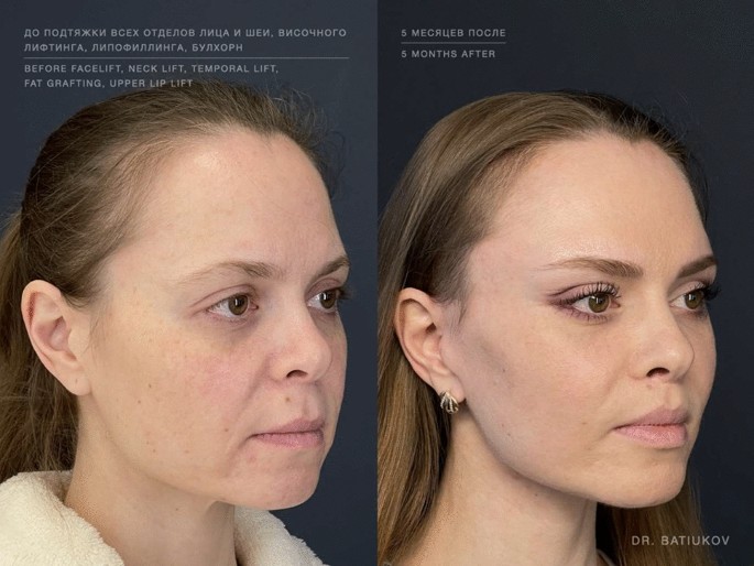 Lifting Facial en Dallas - Clinique Dallas Cirugía Plástica Cosmética