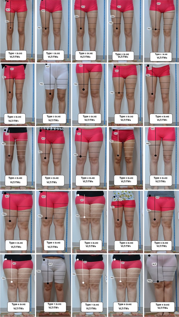 Analysis of the Thigh Aesthetic Profiles: One of Physical Ideal Body  Proportions | Aesthetic Plastic Surgery