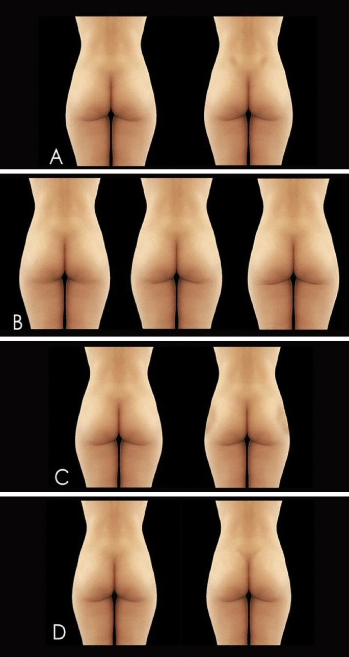 buttocks 