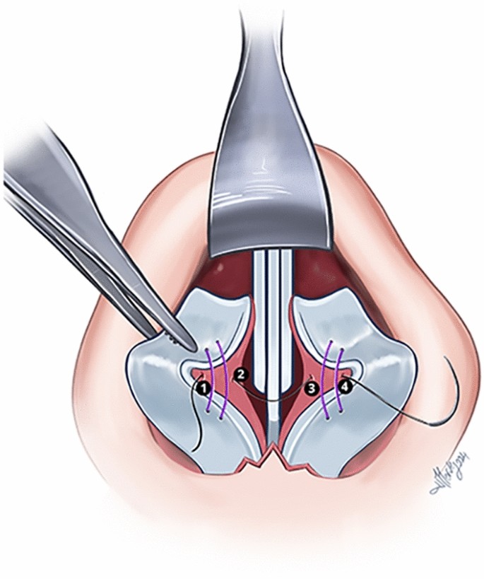 A Suture Technique for Nasal Tip Support: ‘Neo-interdomal Ligament ...