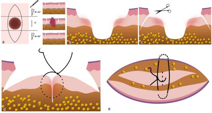 Fusiform Shape Incision A Novel Strategy for Mitigating Central Skin Depression and Dog-Ear ...