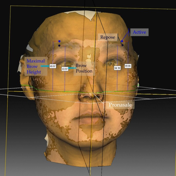 Harnessing the Bidirectional Feature of the Frontalis Muscle: The Super ...