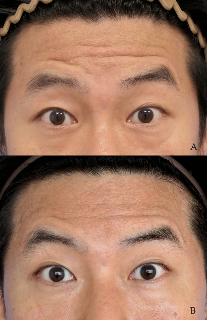 Harnessing the Bidirectional Feature of the Frontalis Muscle: The Super ...