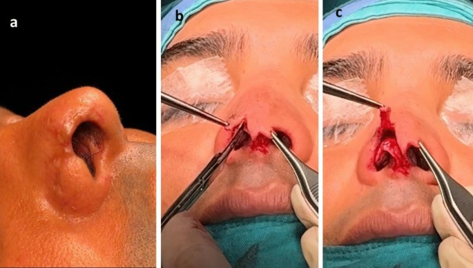 Rotational Columellar Skin Flap for Nasal Alar Rim Reconstruction ...