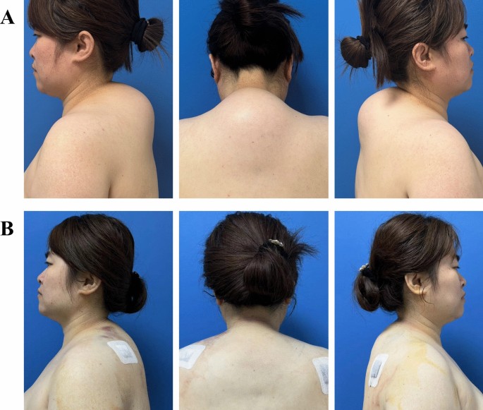 Liposuction with Sharp Cannula to Improve Dorsocervical Fat Pad ...