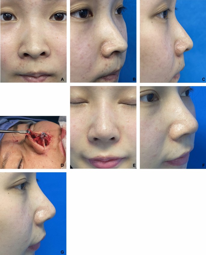 Correction of Alar Retraction by Articulated Alar Rim Graft Combined ...