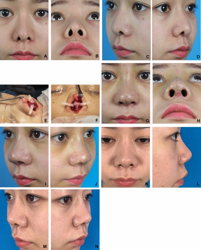 Correction of Alar Retraction by Articulated Alar Rim Graft Combined ...