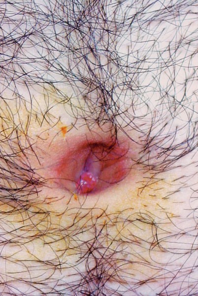 Umbilical Pilonidal Sinus Disease Predisposing Factors And Treatment Springerlink