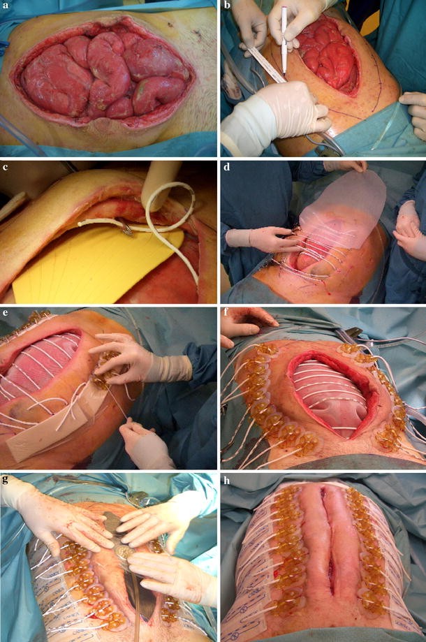 Delayed Primary Closure of the Septic Open Abdomen with a Dynamic Closure  System | SpringerLink