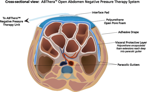 Infracolic Compartment Of The Abdominal Cavity Anatomy Kenhub