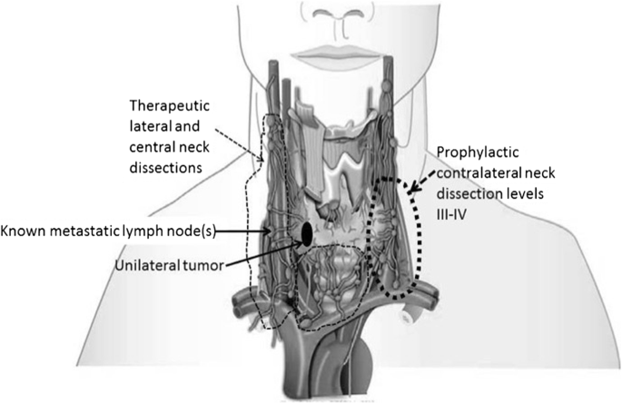 Occult Contralateral Lateral Lymph Node Metastases In Unilateral N1B  Papillary Thyroid Carcinoma | Springerlink