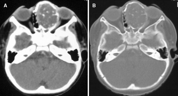 orr papilloma ct