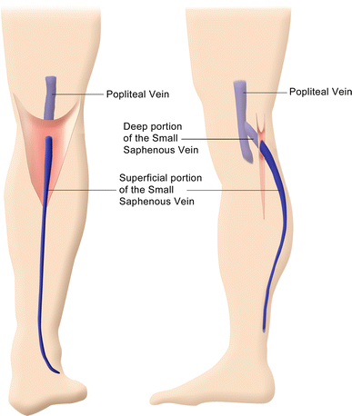 Endovenous Laser Ablation of the Small Saphenous Vein Sparing the  Saphenopopliteal Junction | SpringerLink