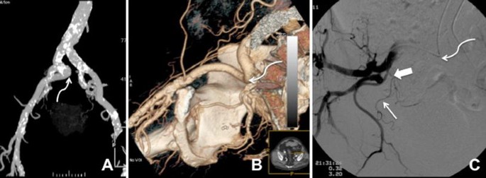 unilateral prostate enlargement)