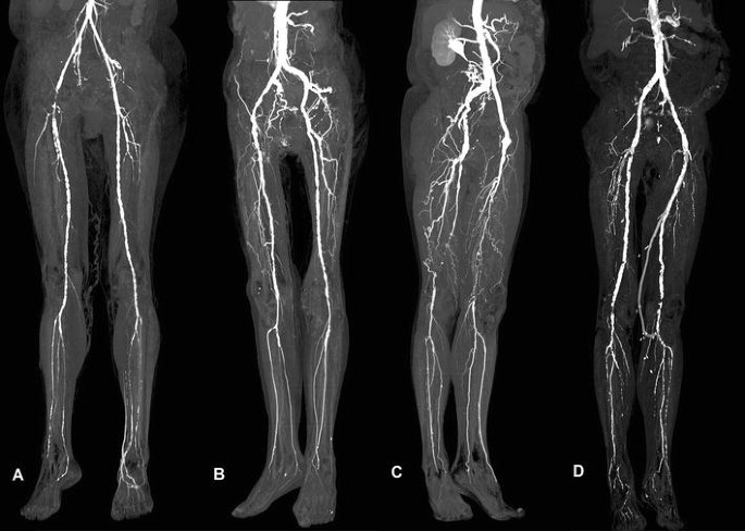 CT Angiography in the Lower Extremity Peripheral Artery Disease Feasibility  of an Ultra-Low Volume Contrast Media Protocol | SpringerLink