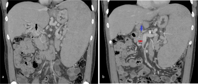 Trans-splenic Sharp Recanalization, Extra-anatomic Portal Vein 