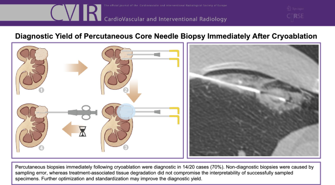 Diagnostic Yield of Percutaneous Core Needle Biopsy Immediately After ...