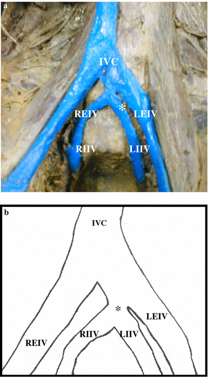 Rare variation in course and affluence of internal iliac vein due to its anatomical and surgical significance | SpringerLink Rare variation in course and affluence of internal iliac vein due to its anatomical and surgical significance | SpringerLink