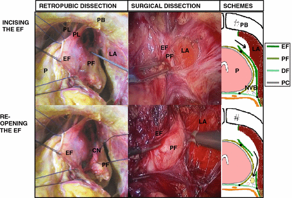 Prospect Diphereline - Cancer Prostata