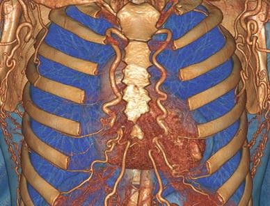 pic Internal Mammary Artery Anatomy autologous breast reconstruction