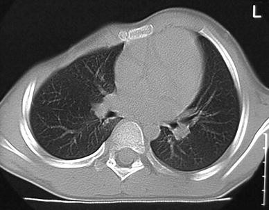 Poland Syndrome From Embryological Basis To Plastic Surgery Springerlink