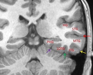 Featured image of post The Best 20 Temporal Lobe Axial Mri Brain Anatomy