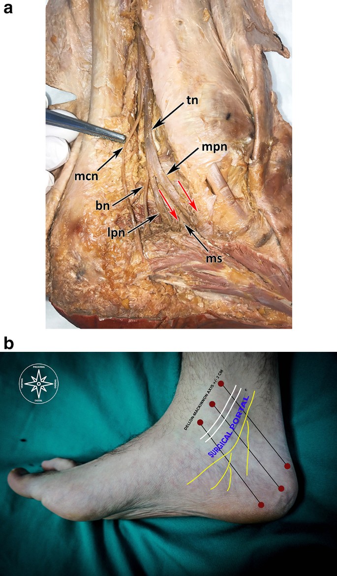 Ultrasound Guided Decompression Surgery Of The Tarsal Tunnel A Novel Technique For The Proximal Tarsal Tunnel Syndrome Part Ii Springerlink