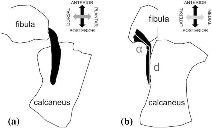 Morphological evaluation of the calcaneofibular ligament in ...
