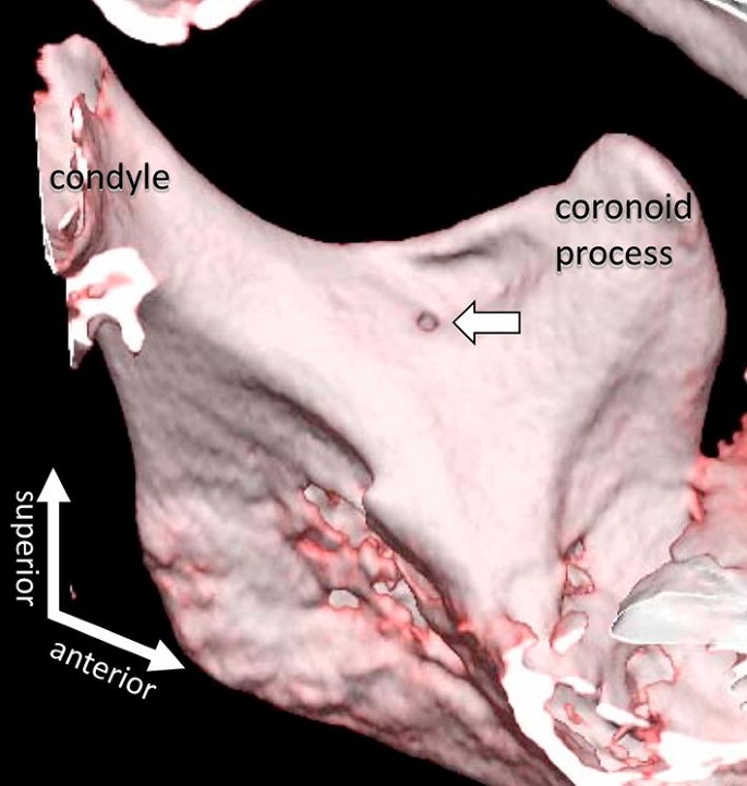 Mandibular nerve , Anatomy QA