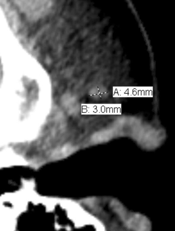 Normative Measurements Of Parotid Lymph Nodes On Ct Imaging Springerlink