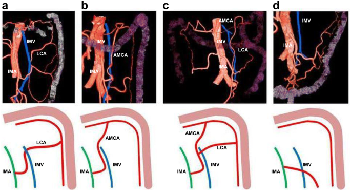 A three-dimensional computed tomography angiography study of the anatomy of the accessory middle colic artery and implications for colorectal cancer surgery | SpringerLink A three-dimensional computed tomography angiography study of the anatomy of the accessory middle colic artery and implications for colorectal cancer surgery | SpringerLink