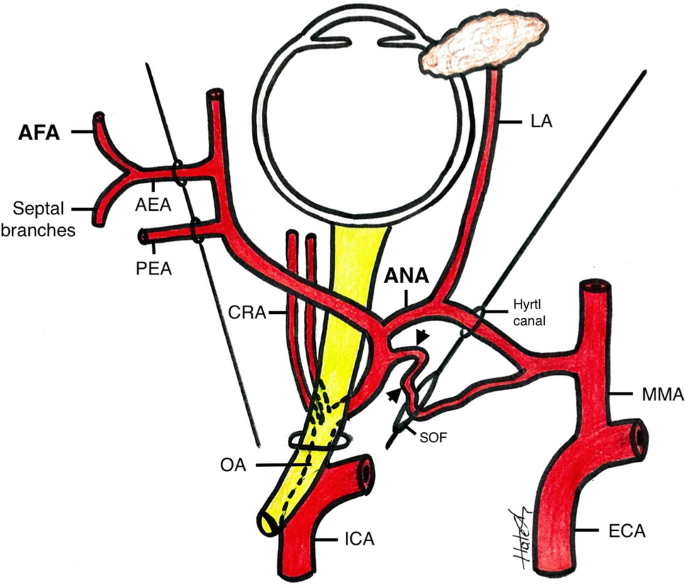 ophthalmic artery dissection
