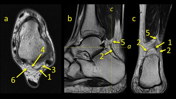 The Kager's fat pad radiological anatomy revised | SpringerLink